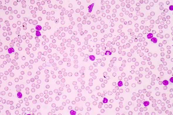 Kinase Inhibitor Intolerance in Patients With Chronic Lymphocytic Leukemia
