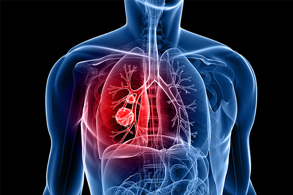 Earlier-Stage Non–Small Cell Lung Cancer: Immunotherapy Highlights
