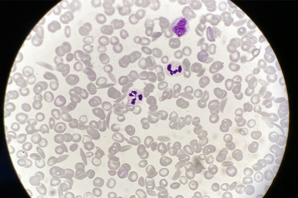 Updates on Gene Therapy for Sickle Cell Disease