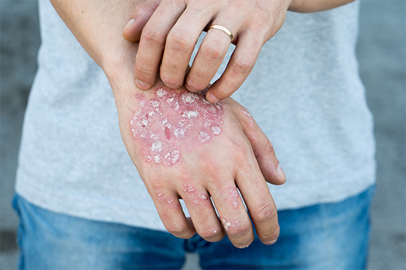 TNF Inhibitor–Induced Psoriasis