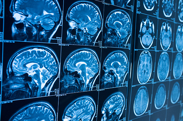 Real-World Effectiveness of First-line Treatment in Relapsing-Remitting Multiple Sclerosis