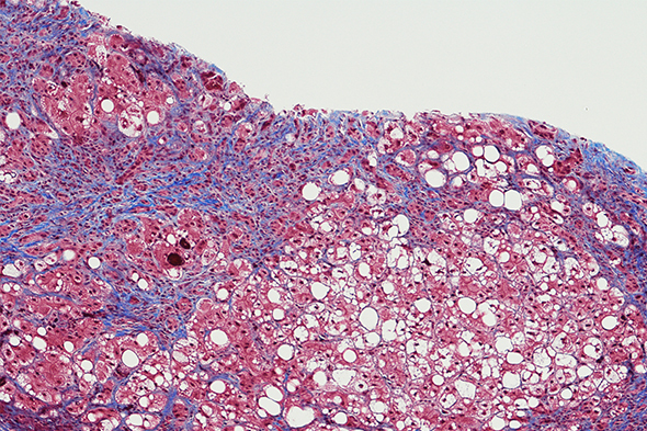 Expert Perspectives in Liver Fibrosis to Cover Key Topics in Liver Fibrosis Treatment