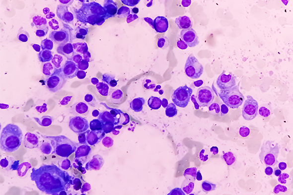 Expert Perspectives in Multiple Myeloma to Cover Key Topics in Multiple Myeloma Treatment