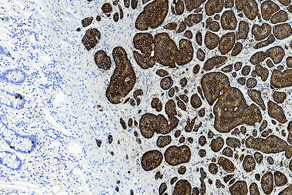 Expert Perspectives in Carcinoid Syndrome to Cover Key Topics in Carcinoid Syndrome Treatment