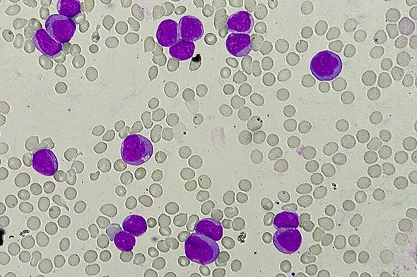 Combination Strategies to Overcome Hypomethylating Agent Resistance