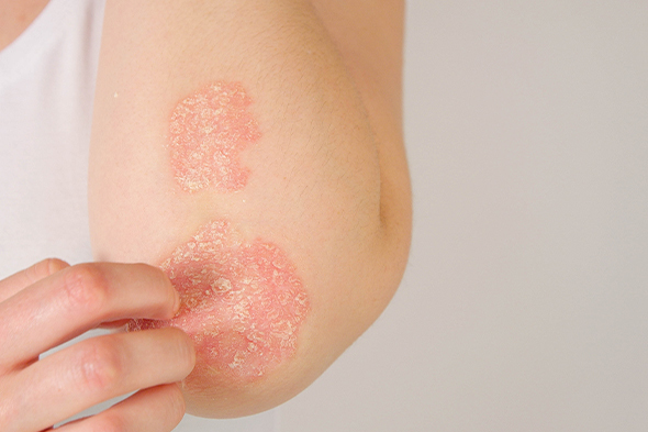 Psoriasis Flare or Diminishing Response to Treatment?