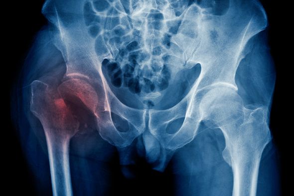 Screening and Treatment for Osteoporosis in Advanced Prostate Cancer