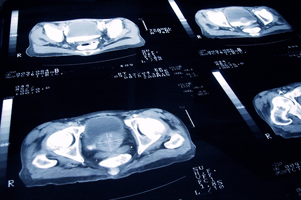 Combinatorial Strategies in Metastatic Castration-Resistant Prostate Cancer