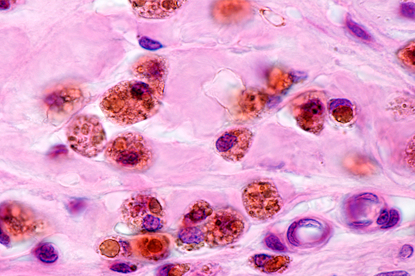 Targeting CSF1R-Dependent Macrophages Associated With Fibrosis in Chronic Graft-versus-Host Disease