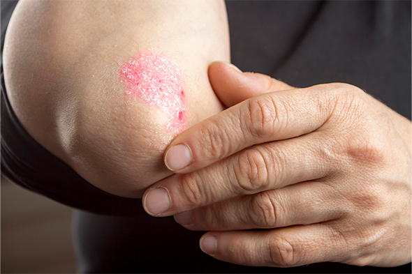 The Rapidly Changing Treatment Landscape of Psoriasis and Psoriatic Arthritis