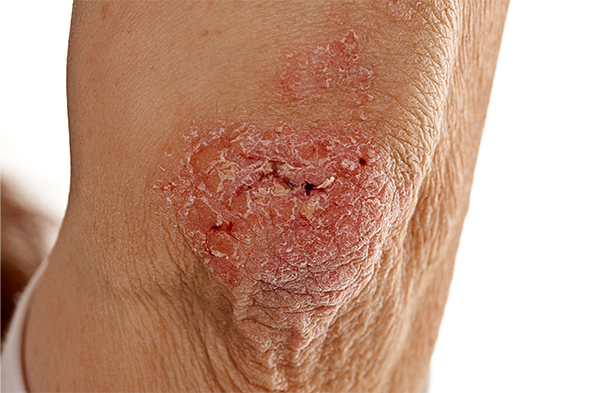 Treating Plaque Psoriasis in Patients With a History of Treated Solid Tumors