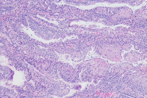 Predicting Endometrial Cancer Recurrence and Response to Adjuvant Therapy