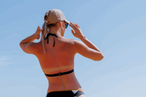 Epidemiology of Basal Cell Carcinoma