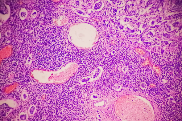Redefining HR+ Disease and Treatment Selection in Metastatic Breast Cancer